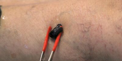 Hirudoterapia – metoda leczenia pijawkami