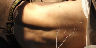 Akupunktura na kręgosłup